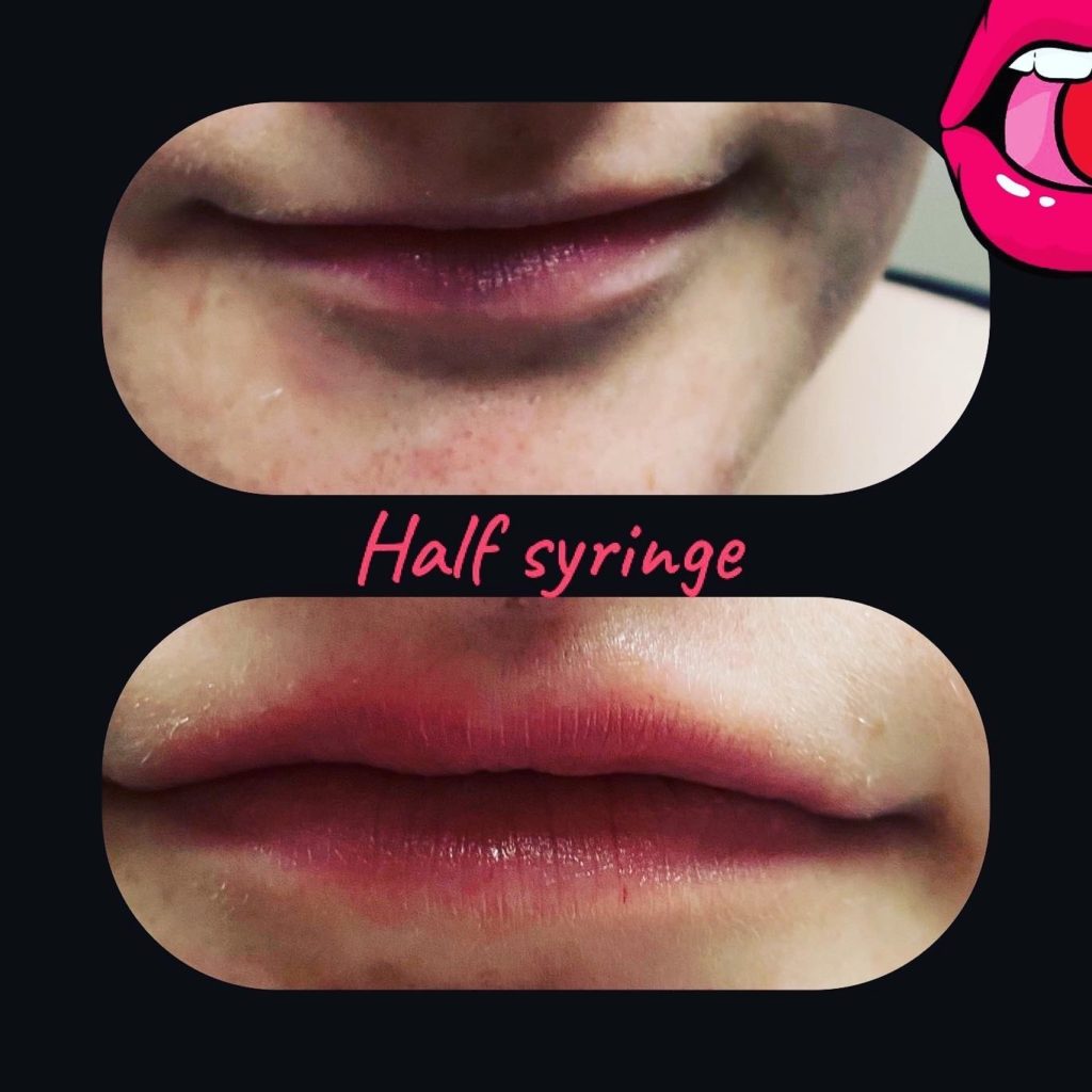 half syringe lips